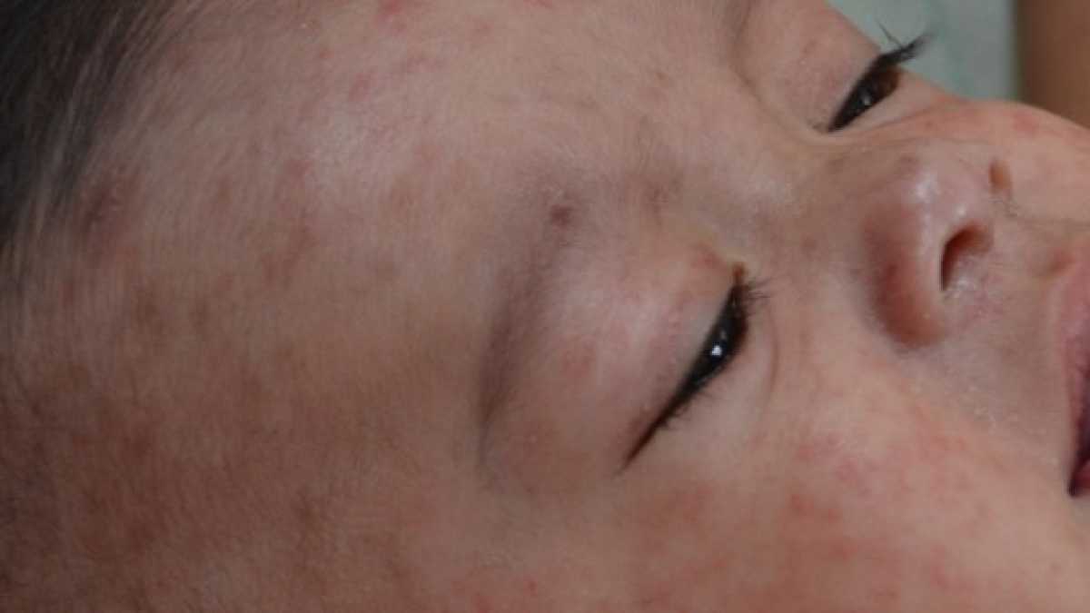 Immagine di Per l'Oms il ritorno del morbillo in Europa è "una tragedia". Peggio dell'Italia solo la Romania
