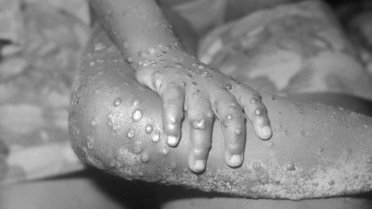 Immagine di Vaiolo delle scimmie: perché è presto per parlare di epidemia