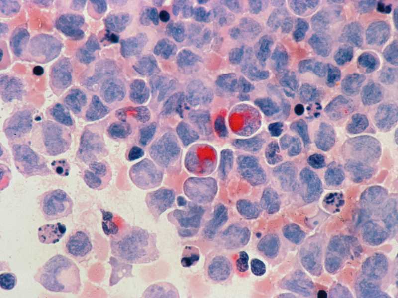 Cellule umane con leucemia mielocitica acuta (National Cancer Institute) <br />