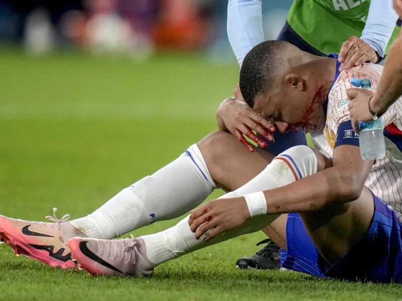 Kylian Mbappé si è rotto il setto nasale nella prima partita della Francia a Euro 2024 (foto Ap, via LaPresse)