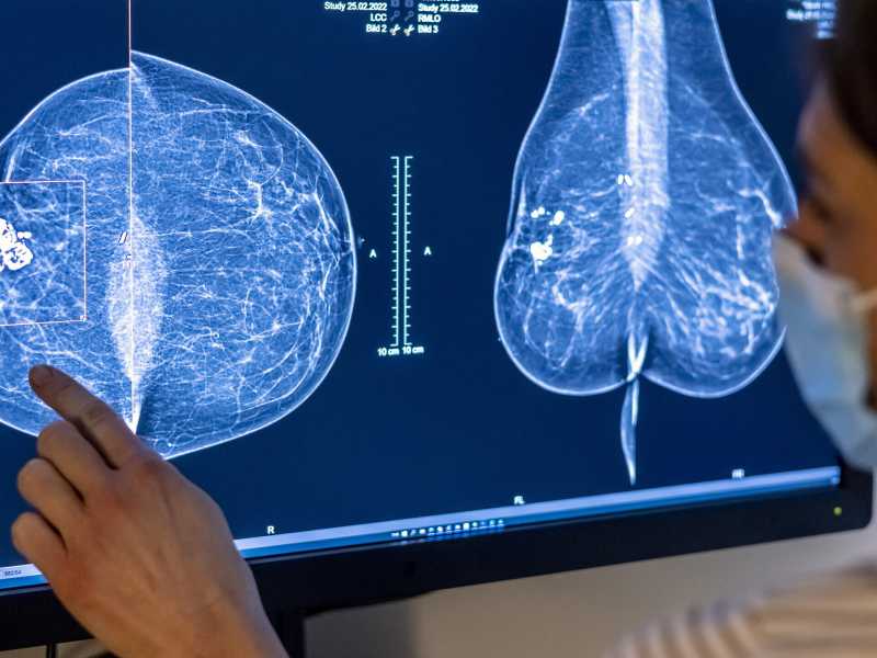 Berlino, il personale medico usa una mammografia per esaminare il seno di una donna (Foto di Michael Hanschke/Getty Images)&nbsp;<br />