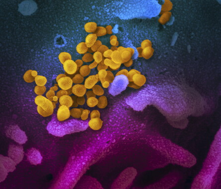 Questa immagine al microscopio elettronico a scansione mostra il nuovo coronavirus (in giallo) tra le cellule umane (blu, rosa e viola). Il colore &egrave; stato aggiunto all'immagine per mostrare meglio il virus e l'ambiente circostante. (immagine NIAID-RML&copy;)
